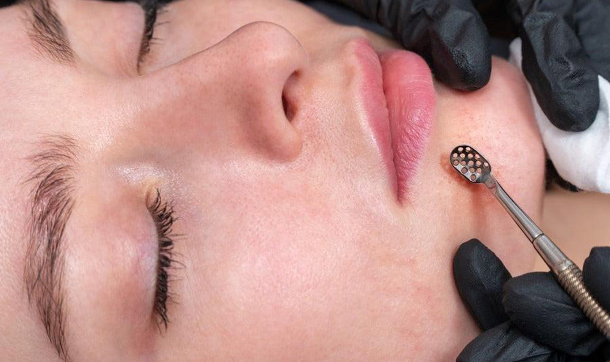 Difference between milia, whiteheads, and fungal acne